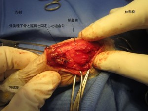 前十字靭帯断裂整復術