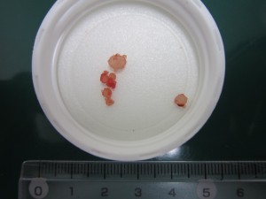 ストルバイト結石